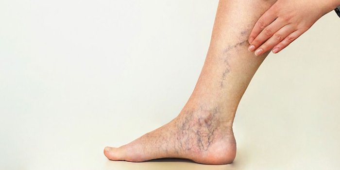 spider veins and varicose veins on a leg