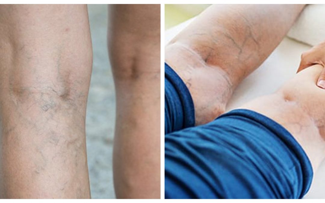 Comparison of varicose veins and spider veins on legs